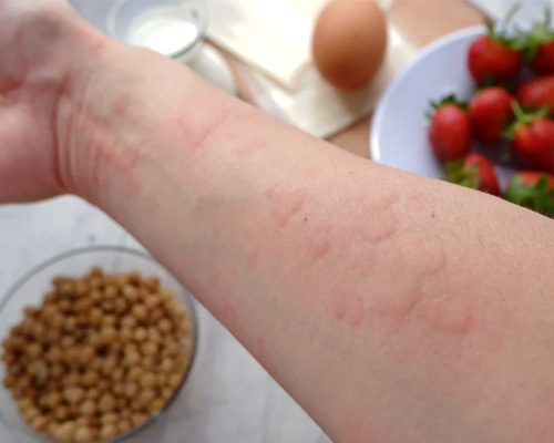 Allergies image